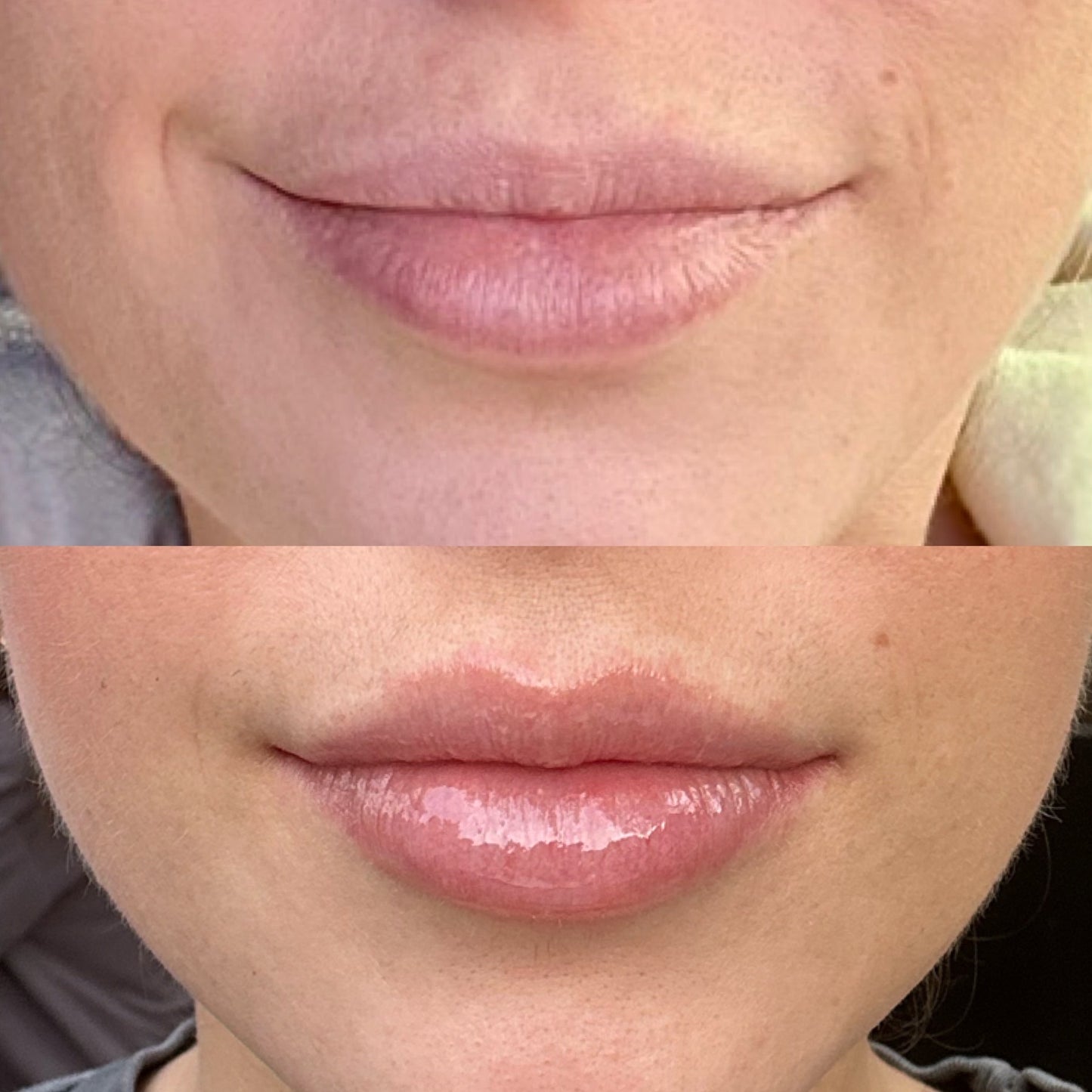 LIP + LASH